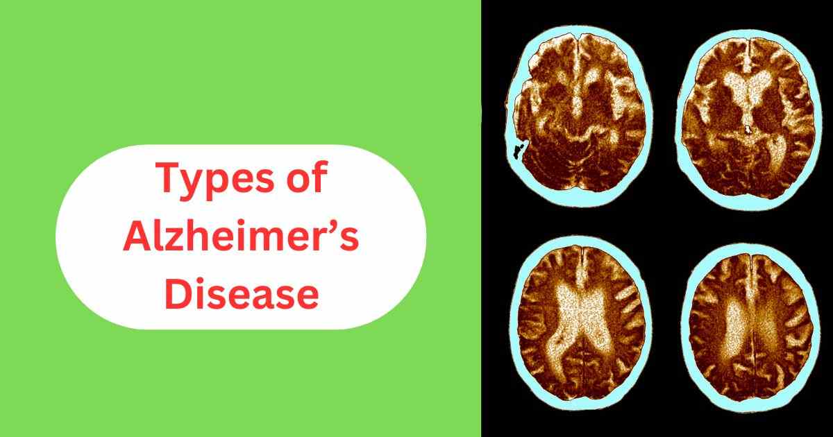 Types of Alzheimer's disease.